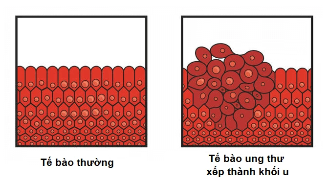 tế bào ung thư